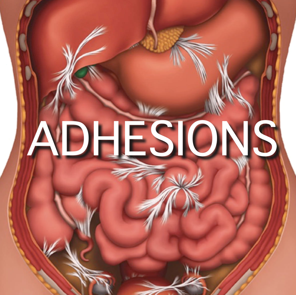 Abdominal Adhesions