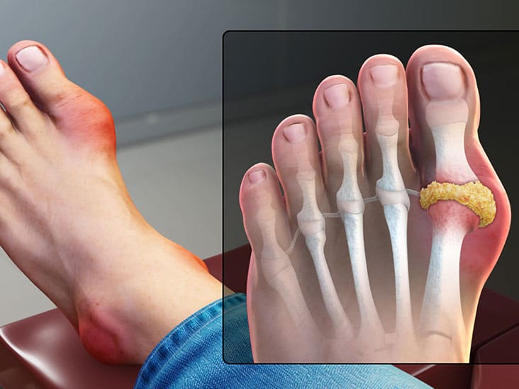 Big Toe Joint Pain | Hill Regional Hospital