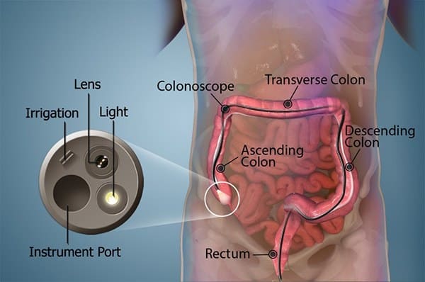 why colonoscopy is important?