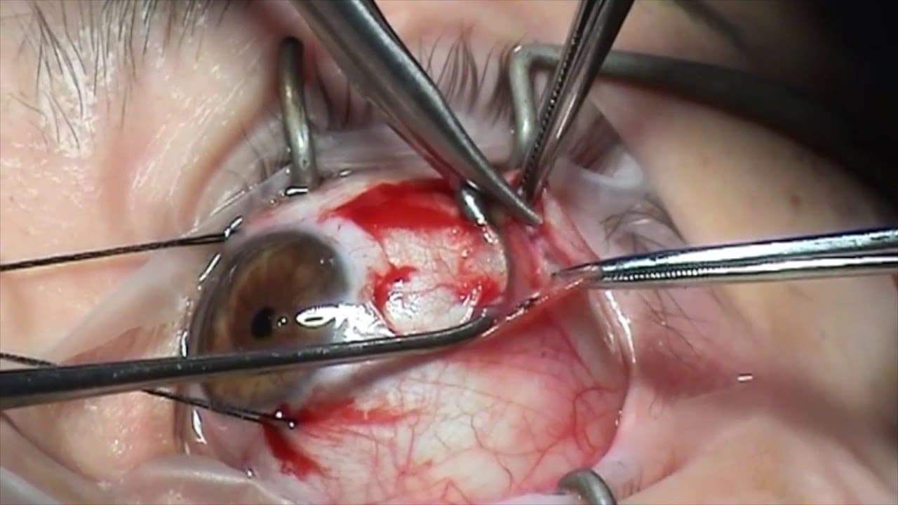 Eye Muscle Repair Surgery