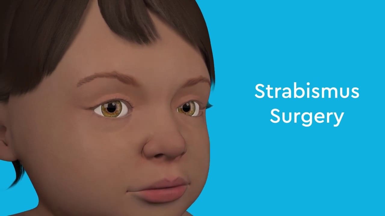 Strabismus