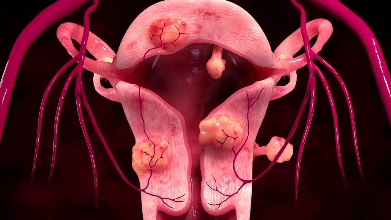 what-is-uterine-artery-embolization-hrh