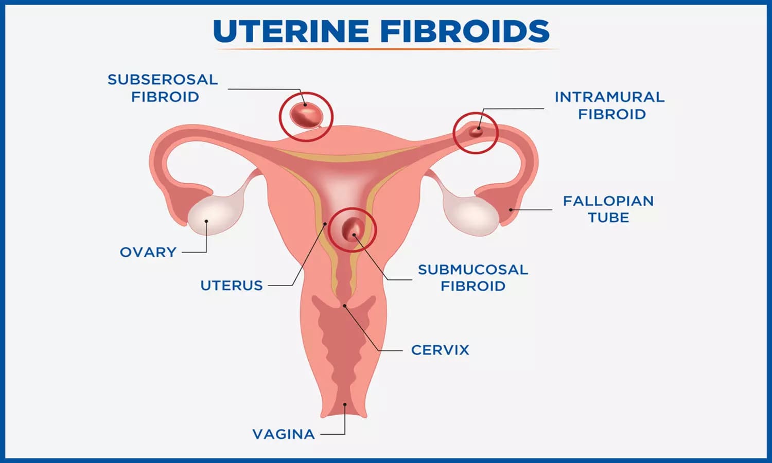 Uterine Artery Embolization (UAE)