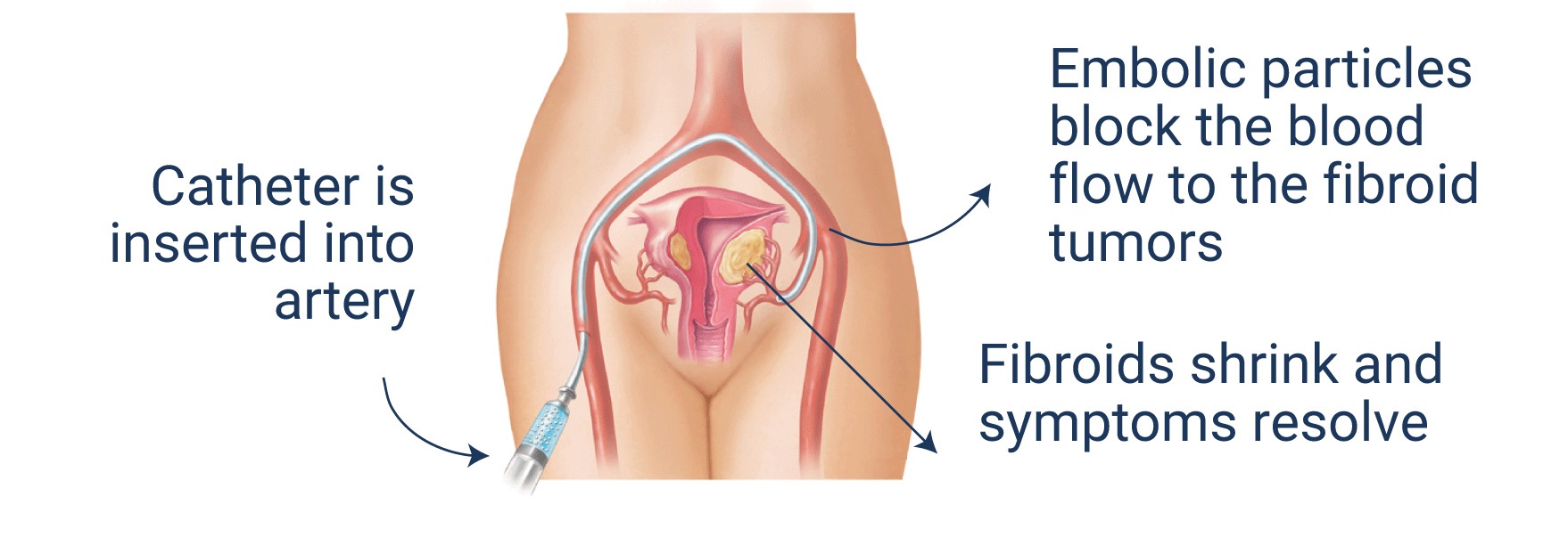 Uterine Artery Embolization Procedure