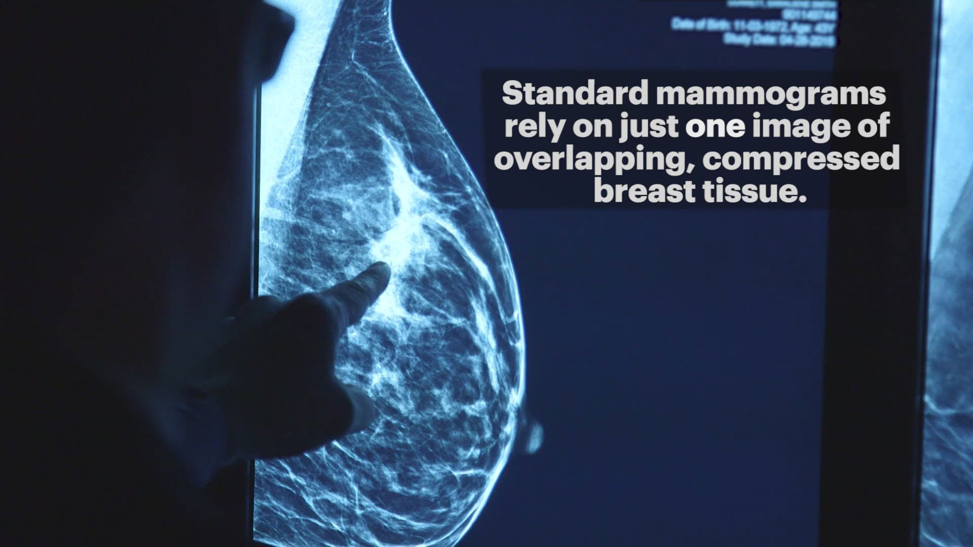 3d Mammogram Procedure