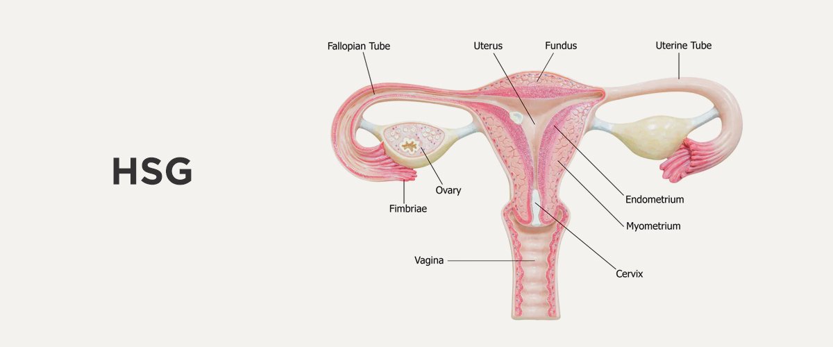 What is Hysterosalpingography?