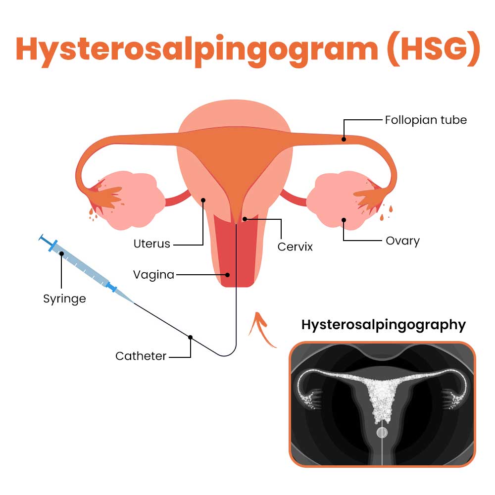 Hysterosalpingography (HSG)