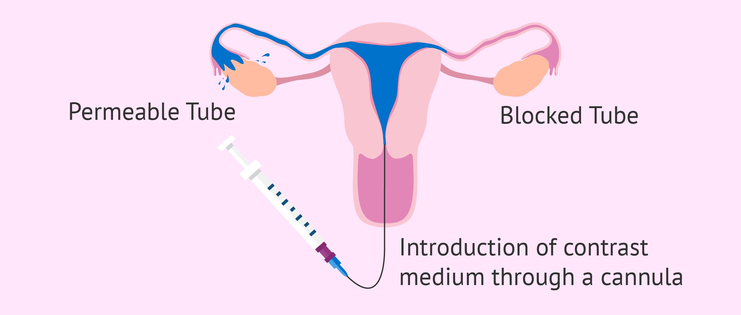 Hysterosalpingography Procedure