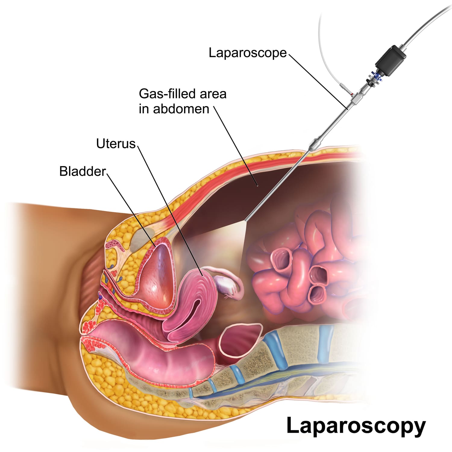 Pelvic Laparoscopy