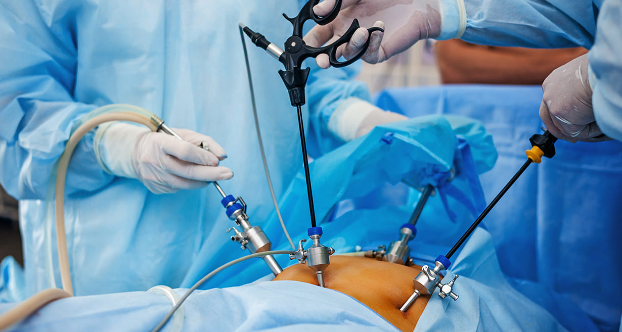 Pelvic Laparoscopy Procedure