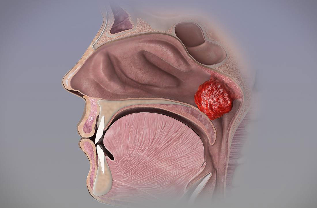 Tonsillectomy Procedure