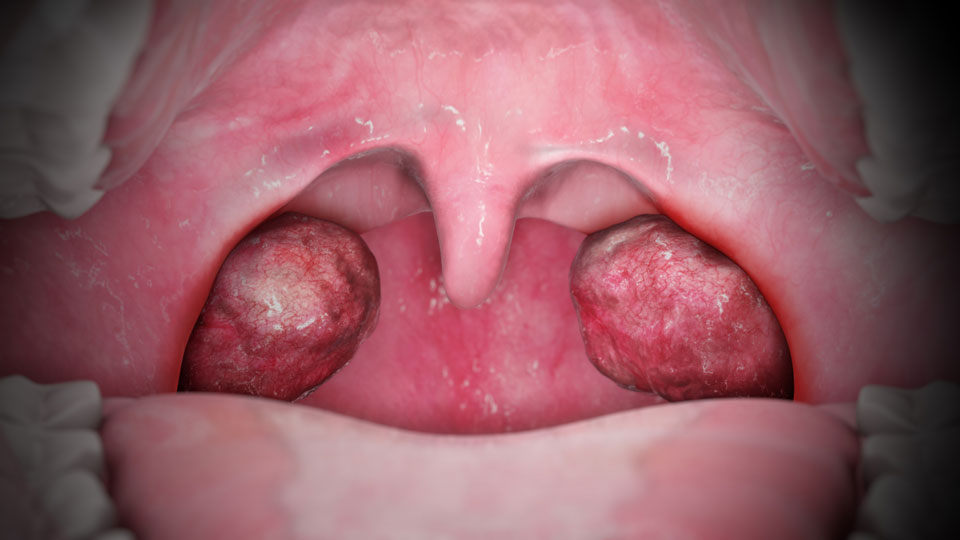 Enlarged Tonsils