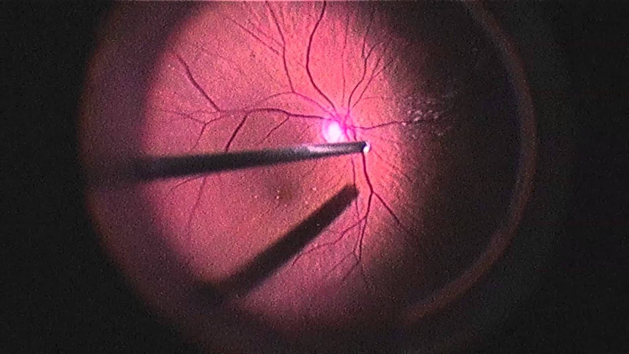 What is Eye Muscle Repair Surgery?