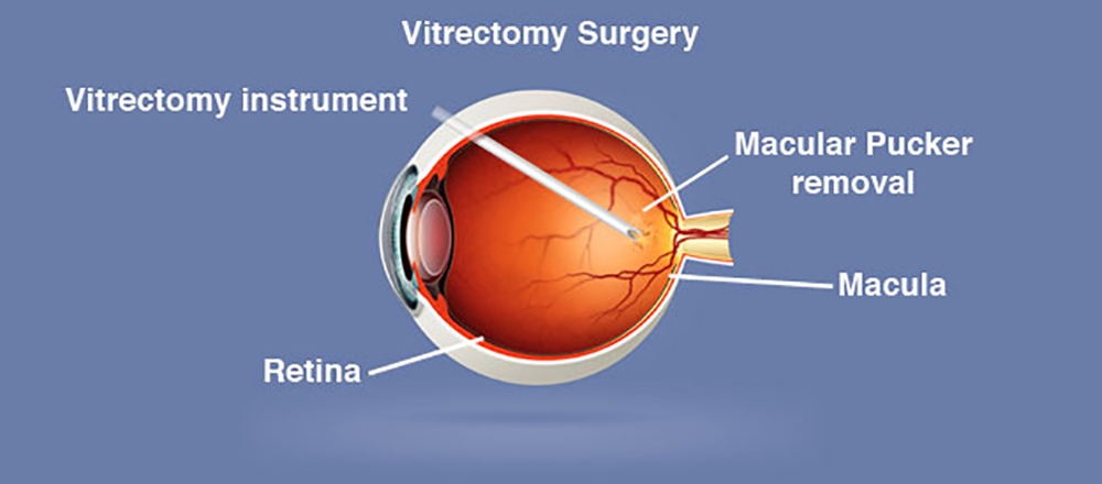 Strabismus