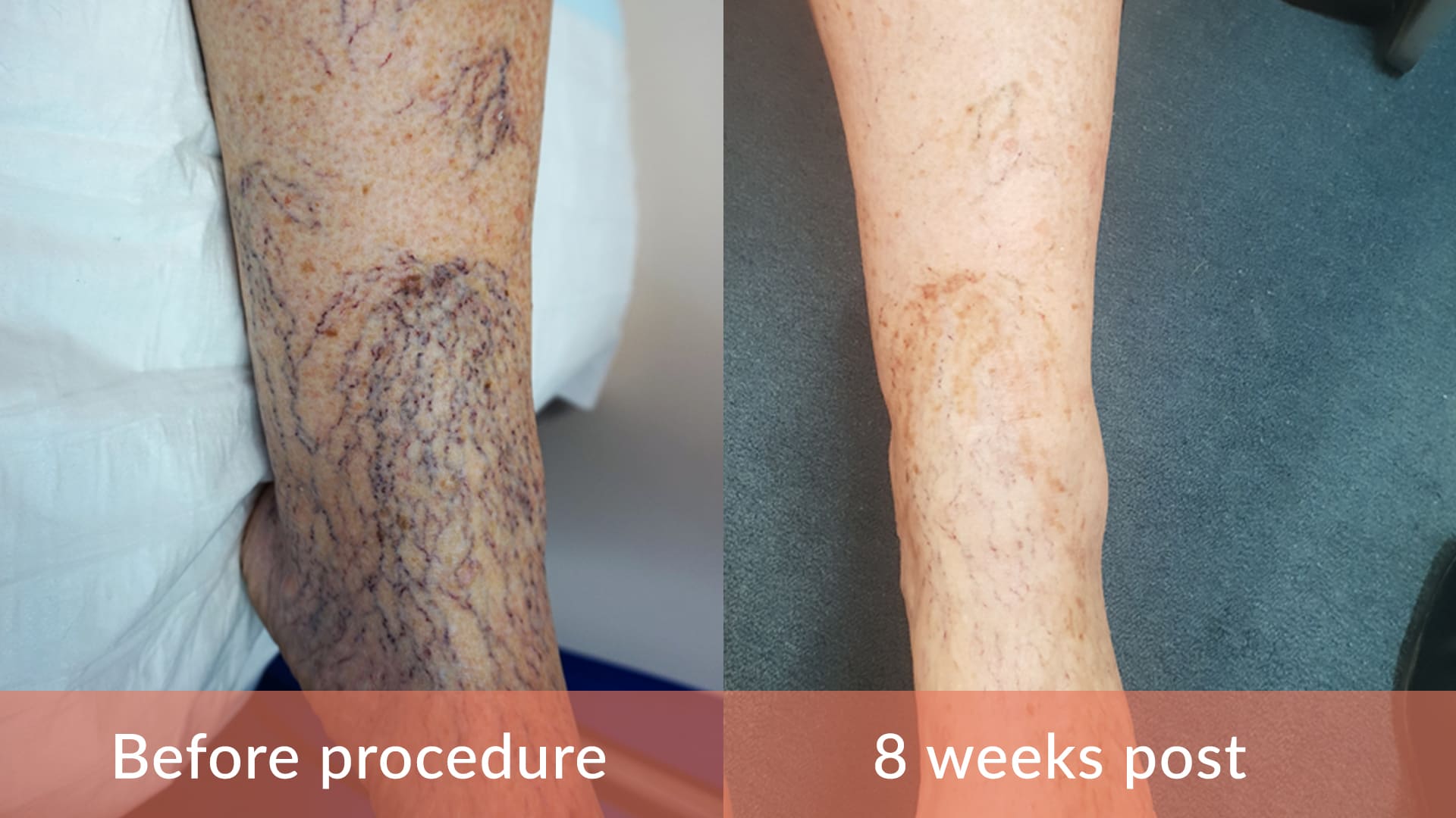 Sclerotherapy Procedure